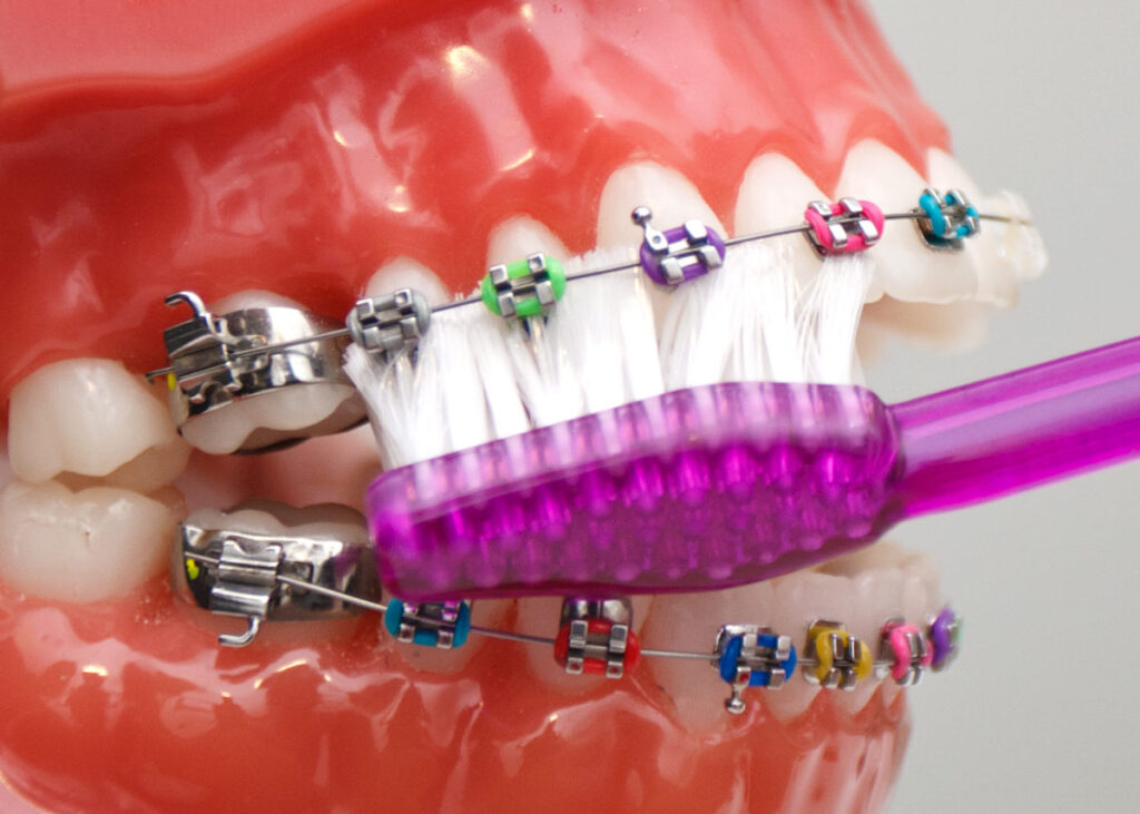 diş telleri ile diş fırçalama